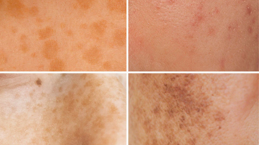 How I Faded My Dark Spots & Redness - and How You Can Too