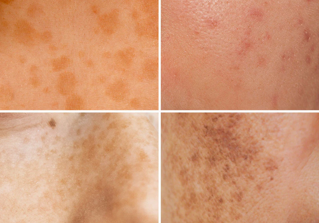 How I Faded My Dark Spots & Redness - and How You Can Too